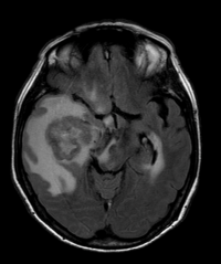 Lymphom des zentralen Nervensystems